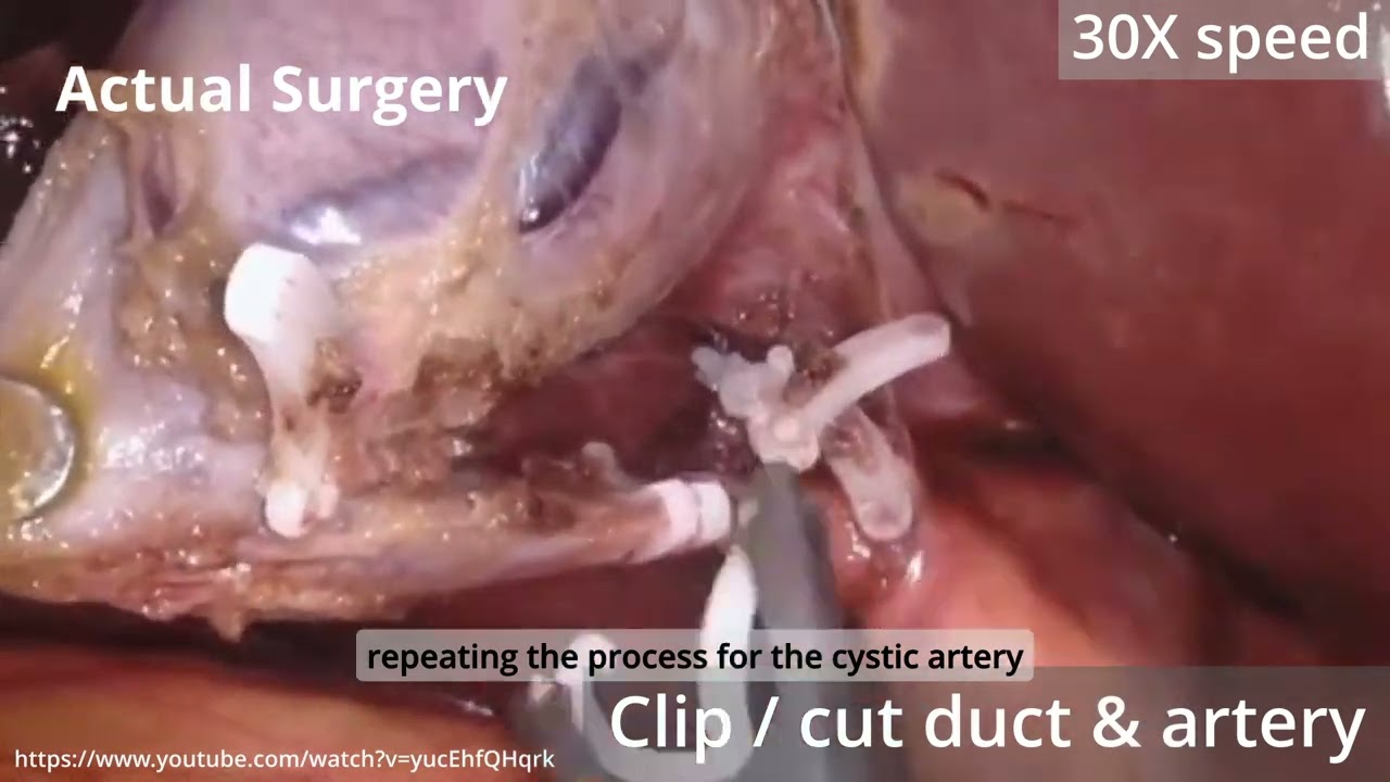 SRT-H: A Hierarchical Framework for Autonomous Surgery via Language Conditioned Imitation Learning