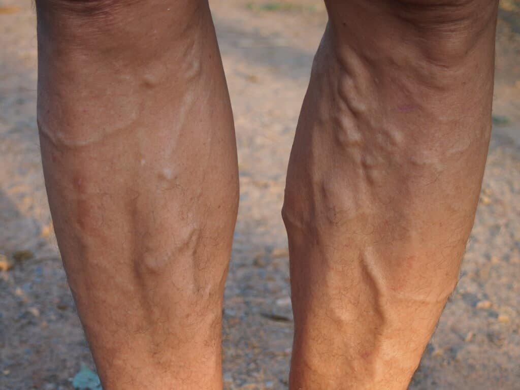 varicose veins